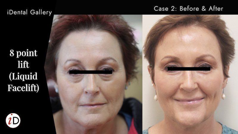 8-point lift before and after liquid facelift