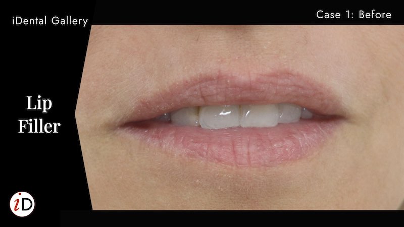 Lip filler enhancement balwyn dentist