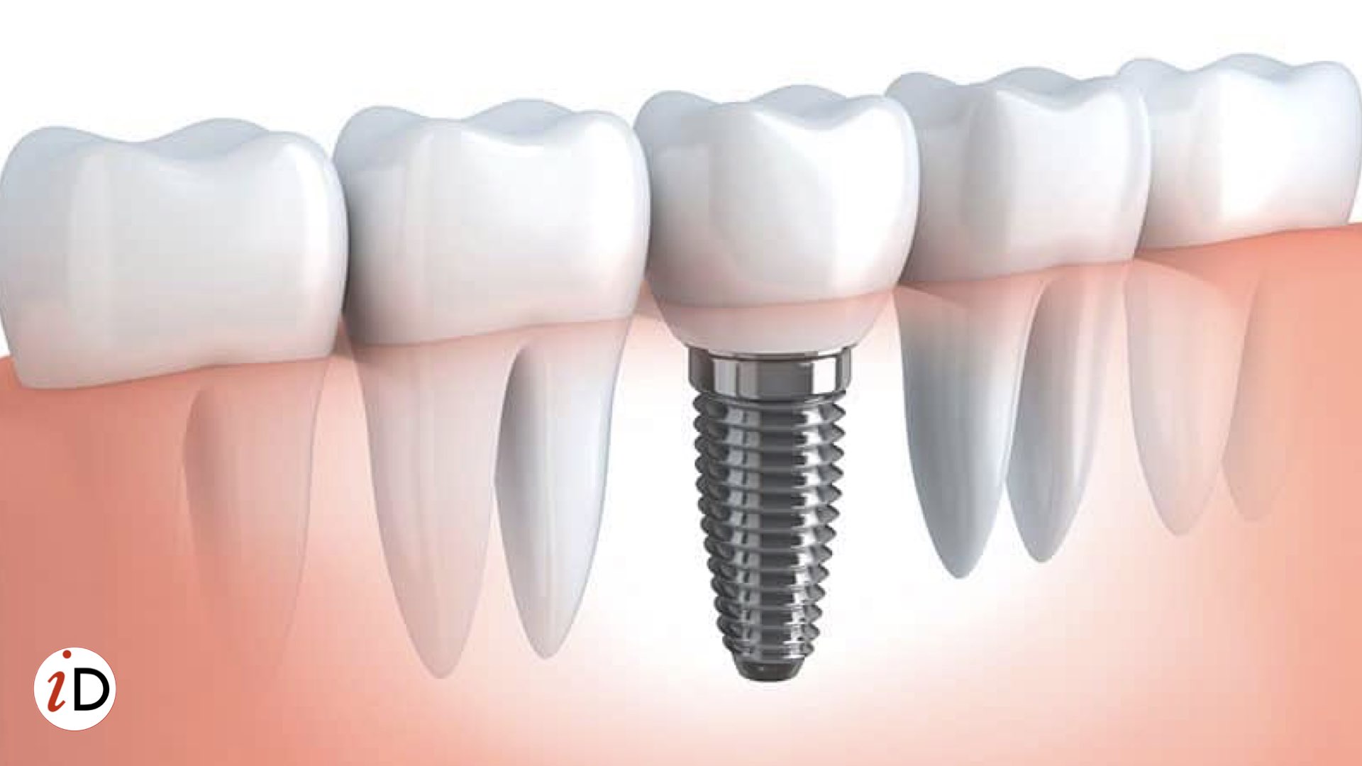 dental implants idental