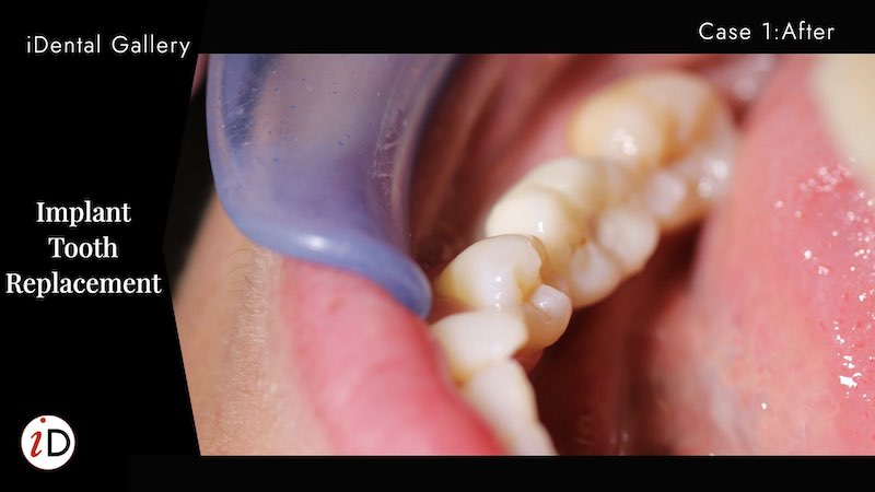 dental implant after balwyn