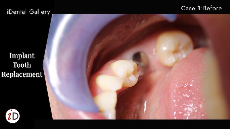 dental implant before balwyn