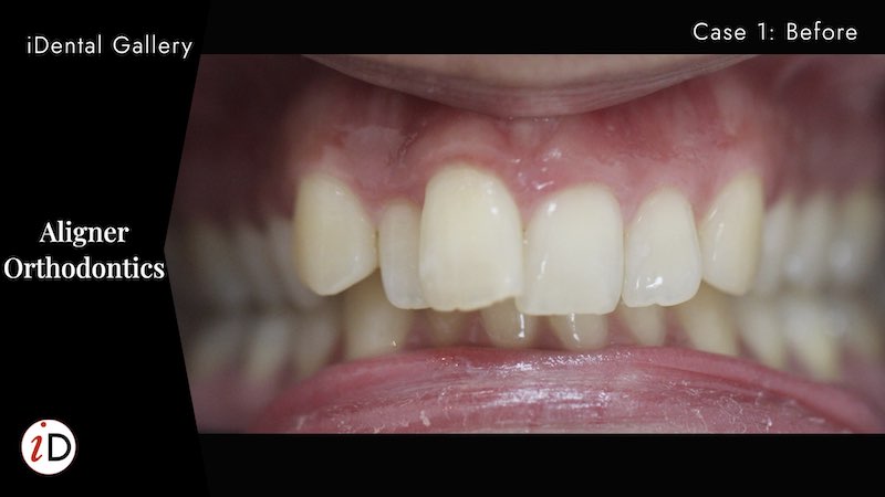 orthodontics aligners before and after balwyn