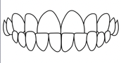 dental underbite correction