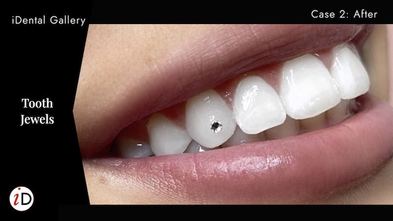 tooth jewels balwyn