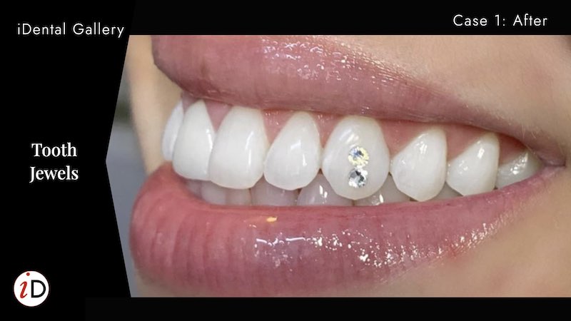 tooth jewels balwyn diamond
