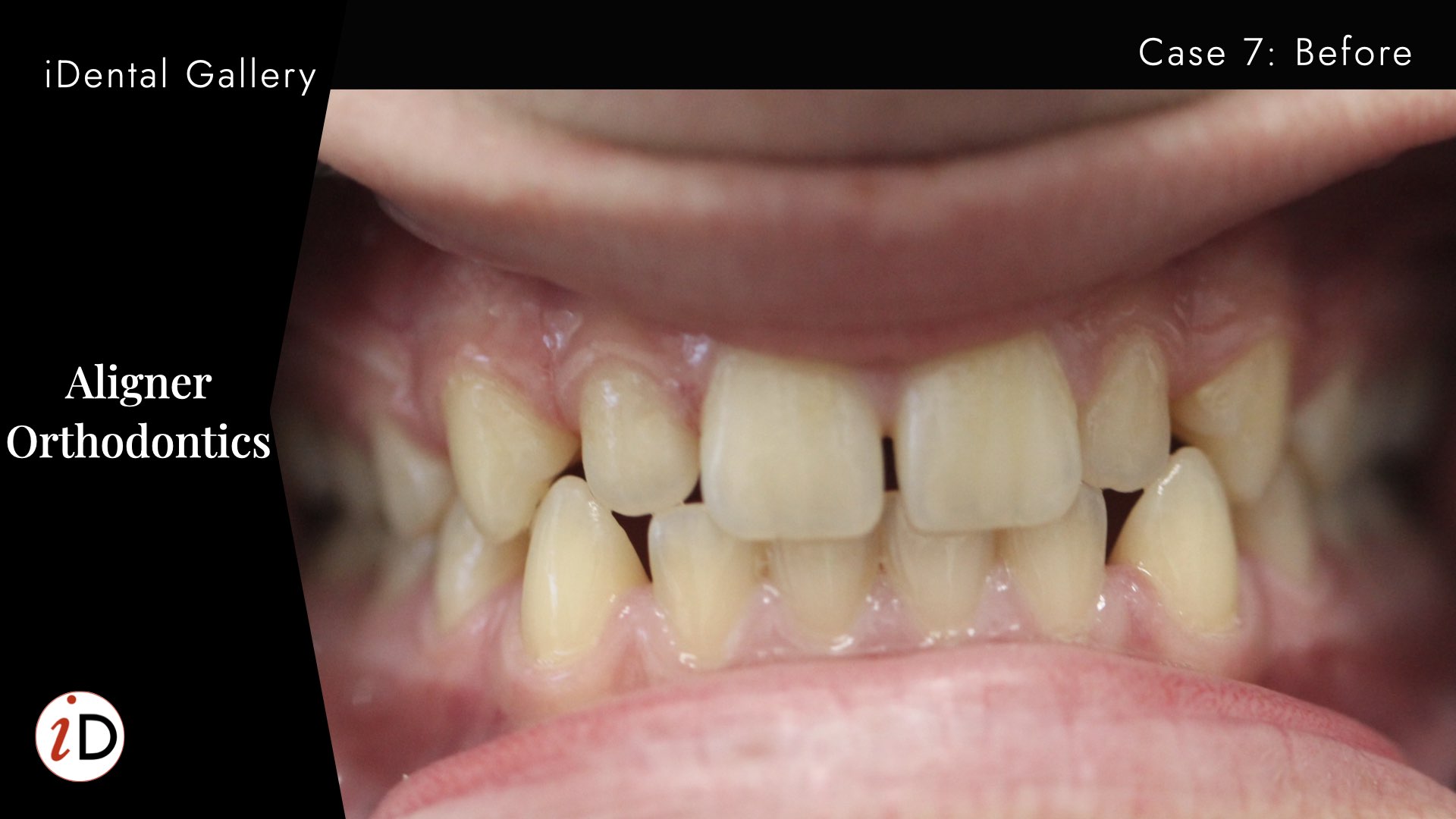 orthodontics aligners before and after balwyn