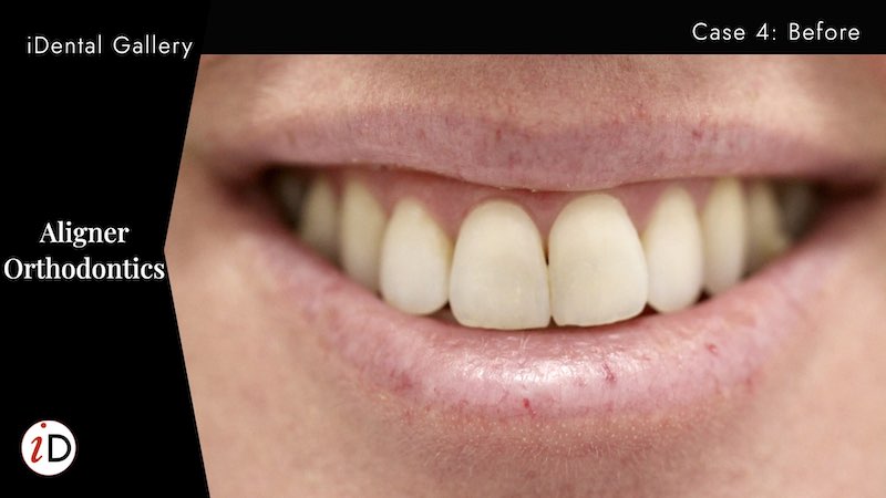 Smilestyler orthodontic treatment balwyn