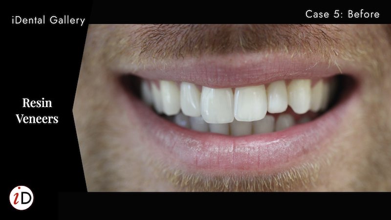 crooked teeth resin veneers