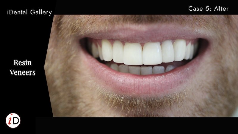 crooked teeth resin veneers after