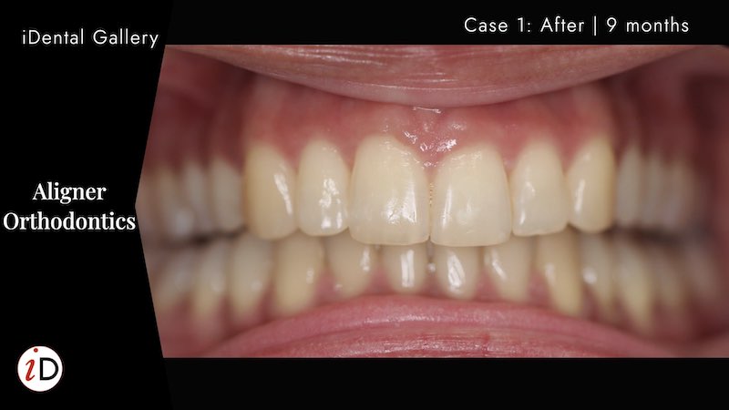 ALIGNERS | CASE 1 | AFTER