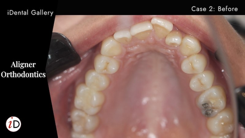 ALIGNERS | CASE 2 | BEFORE